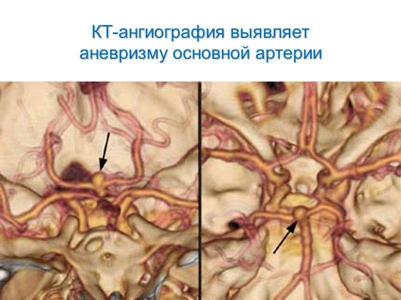 КТ-ангиография выявляет  аневризму основной артерии